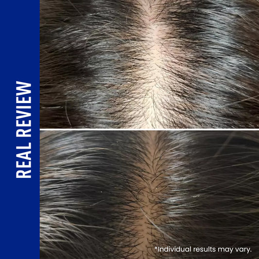 ViveLab Spioxyl™ Scalp Serum 400 – 220K Micro-Spicules for Thicker, Fuller Hair | Korea’s Best-Selling Dermatologist-Recommended K-Beauty Scalp Serum (0.5 fl oz)