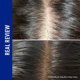 ViveLab Spioxyl™ Scalp Serum 400 – 220K Micro-Spicules for Thicker, Fuller Hair | Korea’s Best-Selling Dermatologist-Recommended K-Beauty Scalp Serum (0.5 fl oz)