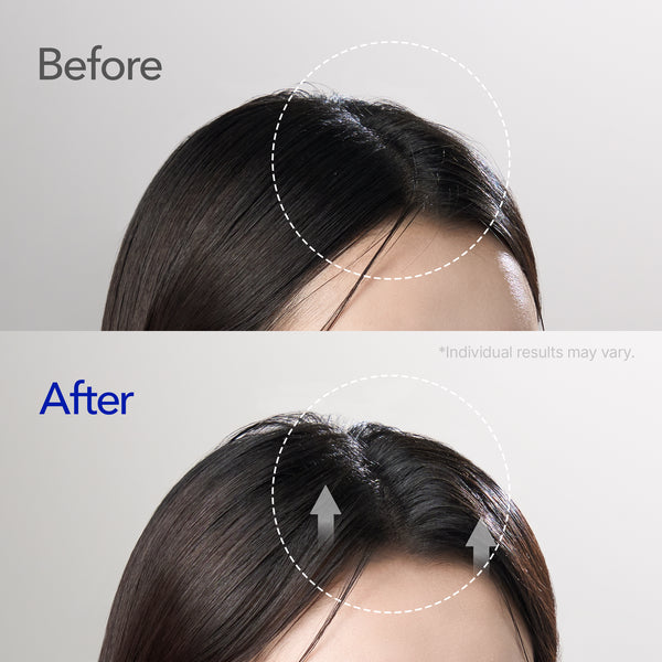 [Buy 1 Get 1] Spioxyl 400 Microneedling Hair Growth Serum