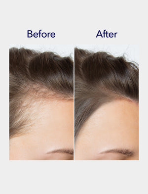 Spioxyl 800 Microneedling Hair Growth Serum
